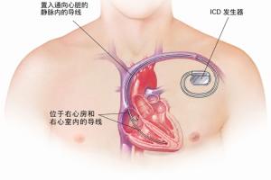 战胜死神！埃里克森植入的ICD是什么？还能从事高强度的运动吗？